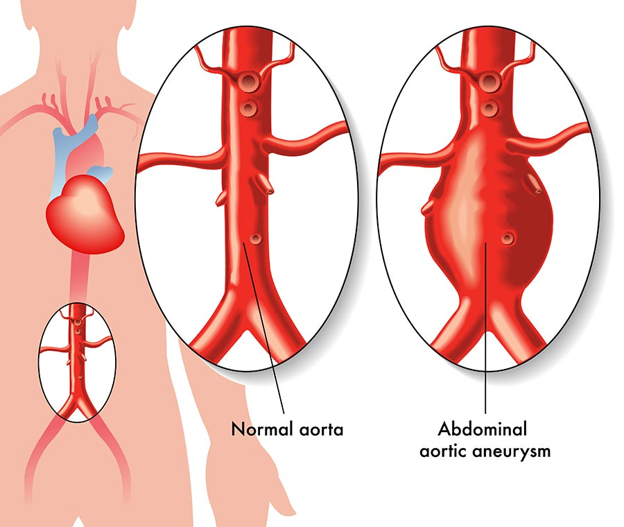 abdominal aorta
