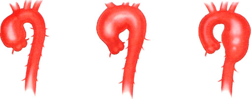 aortic aneurysm 2
