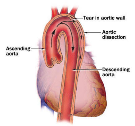 aortic dissection