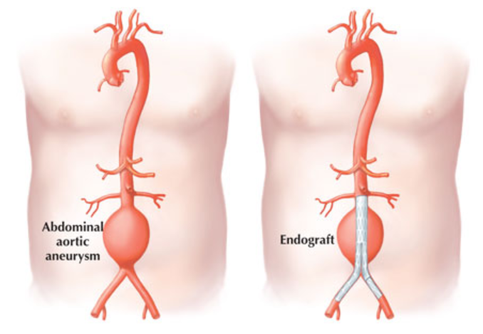 Endovascular Repair