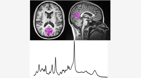 Magnetic Resonance scan and resonance spectroscopy graph