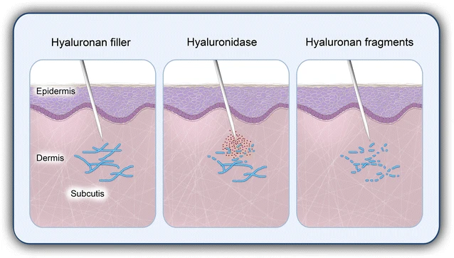 Hyaluronidase catalyzing the decomposition of hyaluronic acid (hyaluronan) in tissues