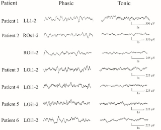 Figure 3: typical EEG activity contrasting phasic versus tonic REM sleep in the primary visual cortex.