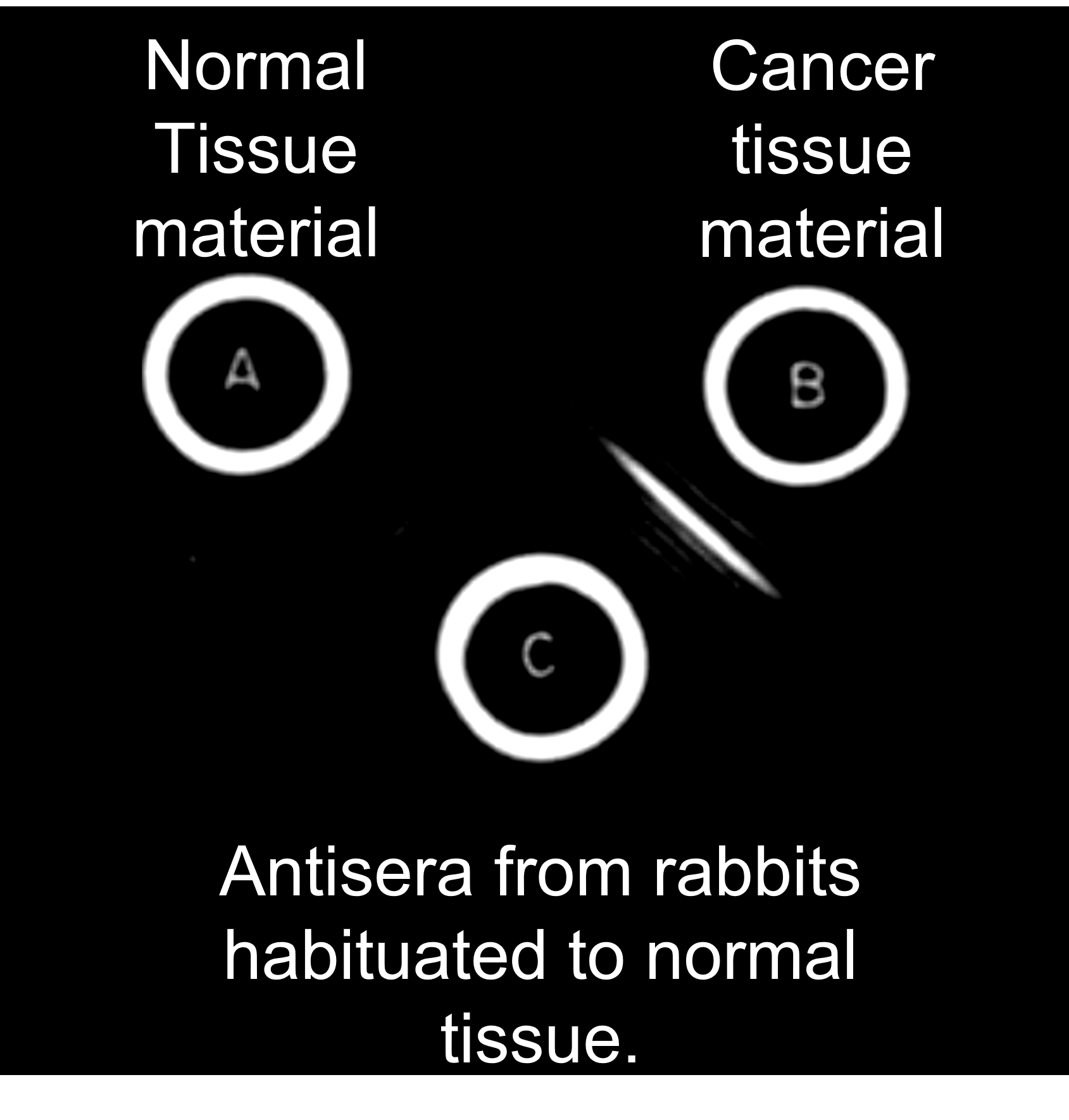 Dr. Phil Gold' 1965 experiment showing that Antisera of rabbit habituated to normal tissue reacts with the colorectal cancer material (B) but not with the normal tissue material, as shown by a band