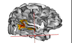 Results from an fMRI study in this patient displayed on the cortical surface.