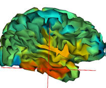 Results for source localization projected on the cortical surface. Note that the findings are consistent with the SEEG.