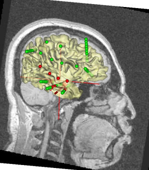 SEEG findings. Green dots represent inactive electrodes, while red dots show electrodes involved in the interictal spike.