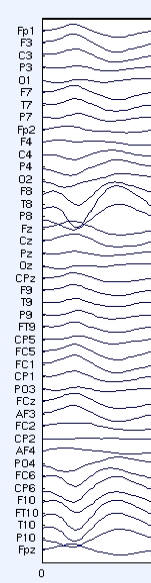 EEG for an interictal spike in a patient.