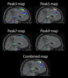 Examples of tmaps for activation. In this case, peak3 and peak5 seem to be the best tmaps. The combined map has the best elements of all the four peak maps.