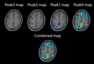 Deactivation maps that show a widespread decrease in deactivation that is not present in peak3 and modeled poorly by peak5. This is an excellent example of how a single HRF model (such as peak5) can miss large widespread deactivations.