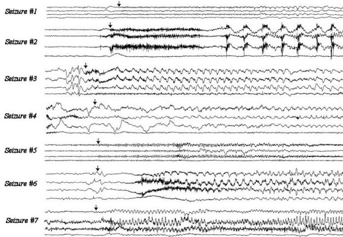 eeg seizure