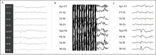 Effects of the MRI on the EEG