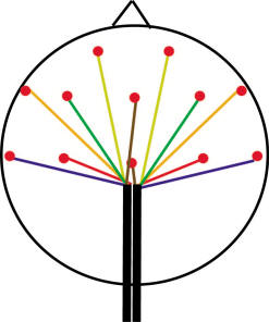 Schematic diagram, showing electrodes (red dots) from 2 cables on the front of the head. The wires are gathered in the black sheaths, which help immobilize the wires and keep them grouped together.