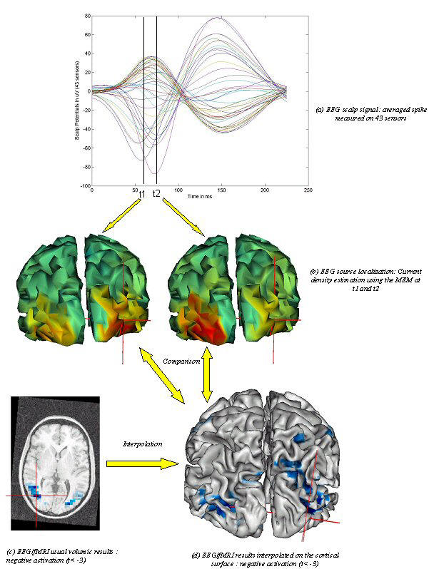 Multimodal analysis of interictal spikes: visual comparison of EEG source localization and fMRI response.
