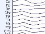 EEG pour un pic interictal chez un patient.