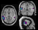 A statistical map of activation in a patient with left temporal spikes. Note the main area of activation on the left side, and the small activation in the contralateral area on the right.