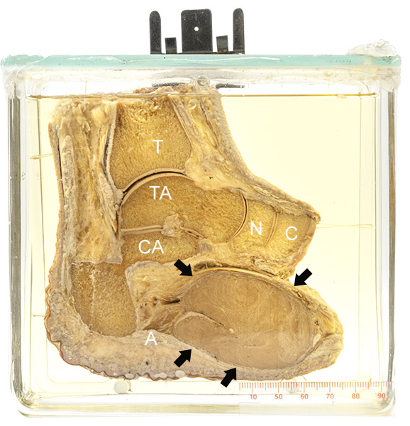 03 Pathology specimen in jar