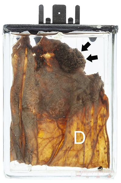 09 Pathology specimen from Maude Abbott Medical Museum