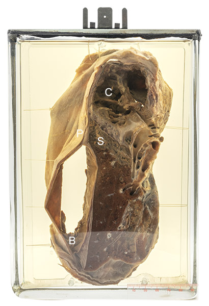 11 Chronic cavitary tuberculosis