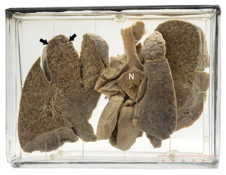 12 Pathology specimen