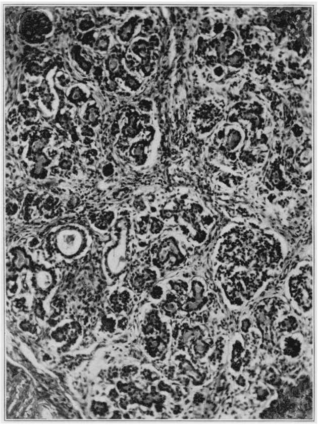 Photomicrograph of the pancreas in a patient with cystic fibrosis who died at the age of 8 weeks. This image was published in Dr. Dorothy Andersen’s original paper describing multiple cases of what she termed “cystic fibrosis”. 