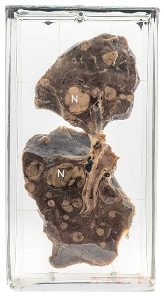 16 Pathology specimen. Metastatic melanoma