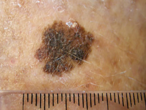 Skin lesion