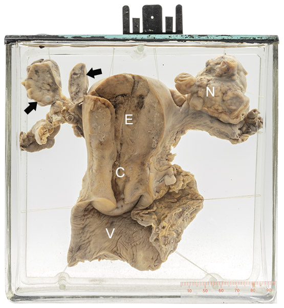 Metastatic carcinoma to ovary
