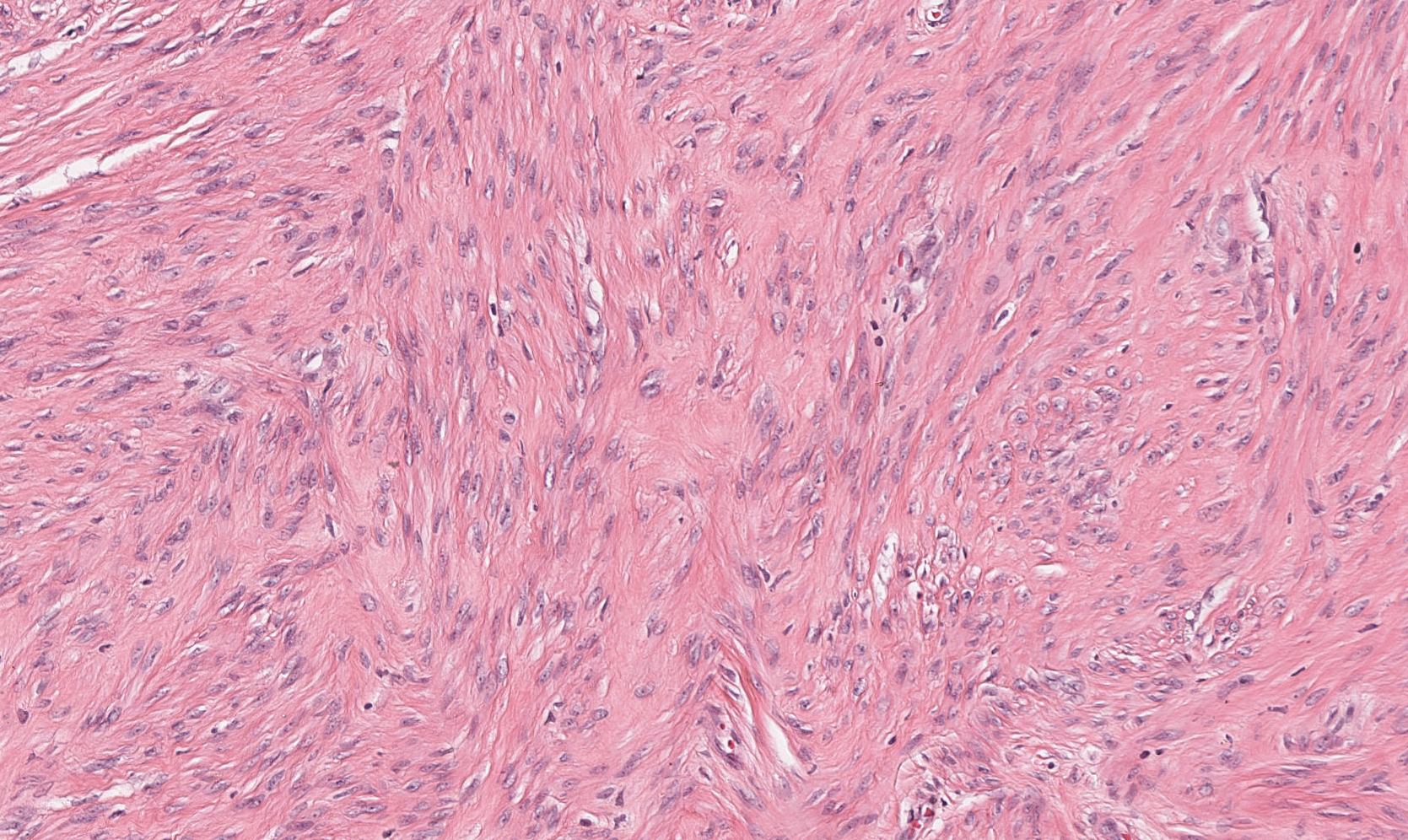Histologic appearance of a leiomyoma showing intersecting fascicles of cells that have elongated (spindle-shaped) nuclei.