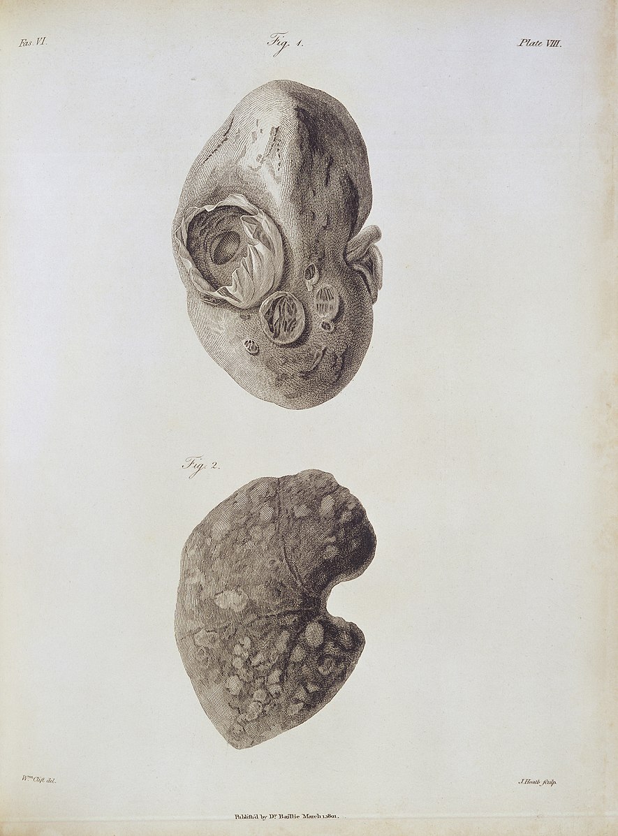 An engraving showing “hydatis of the kidney”, published by Matthew Baillie in 1801. 