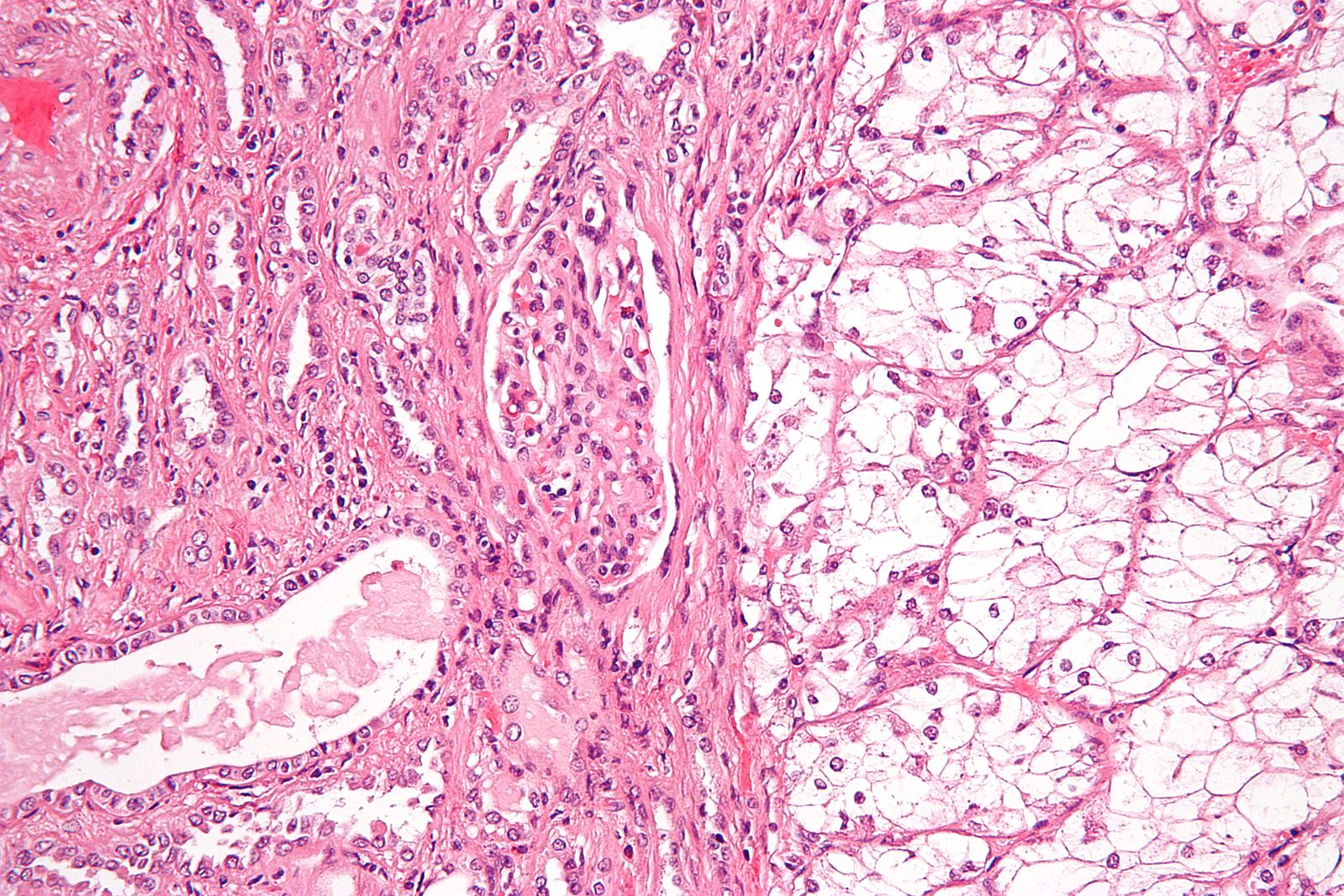 Histologic appearance of clear cell carcinoma on the right; normal kidney tubules are on the left. 