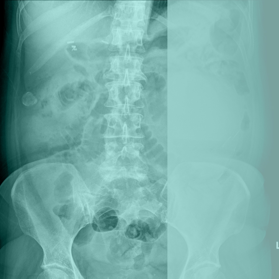 X-ray lumbar spine