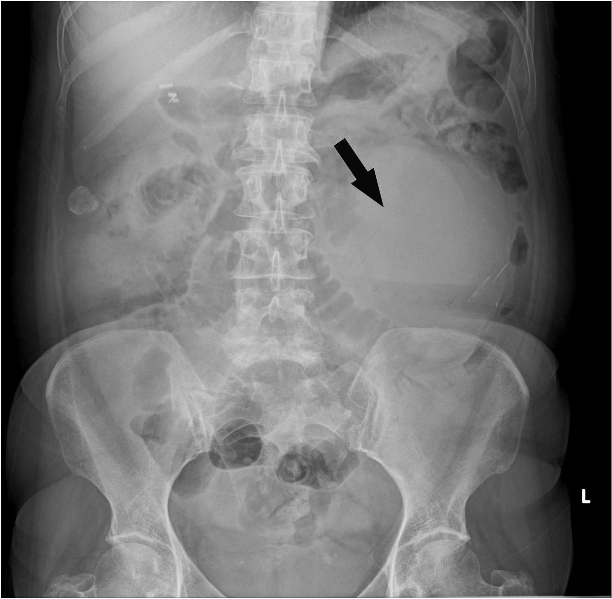 A large renal cyst seen on xray 