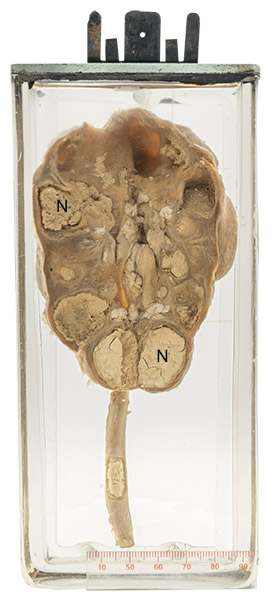 Renal tuberculosis 