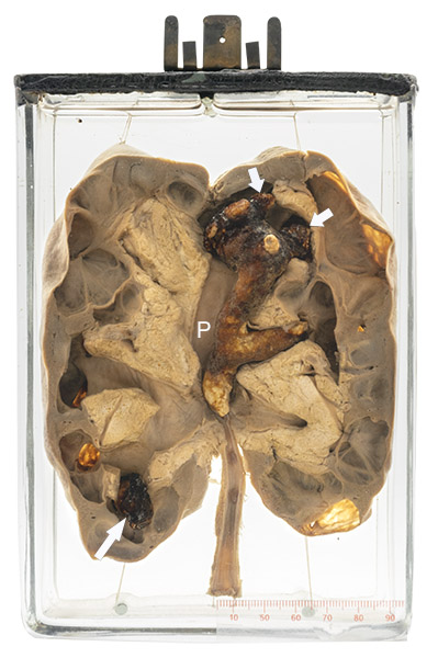 Kidney stones