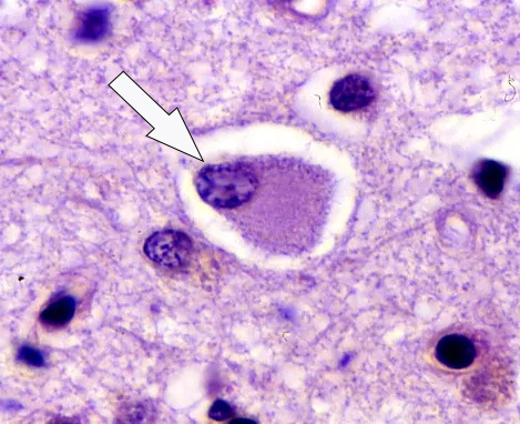 A neuron in the center shows amorphous lightly staining purple material (tau protein) next to the nucleus