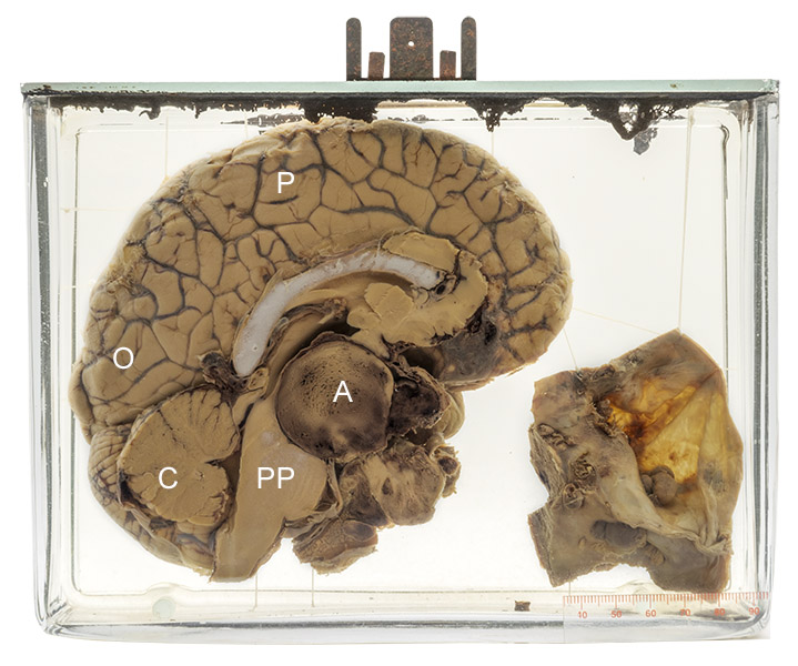 Pituitary adenoma