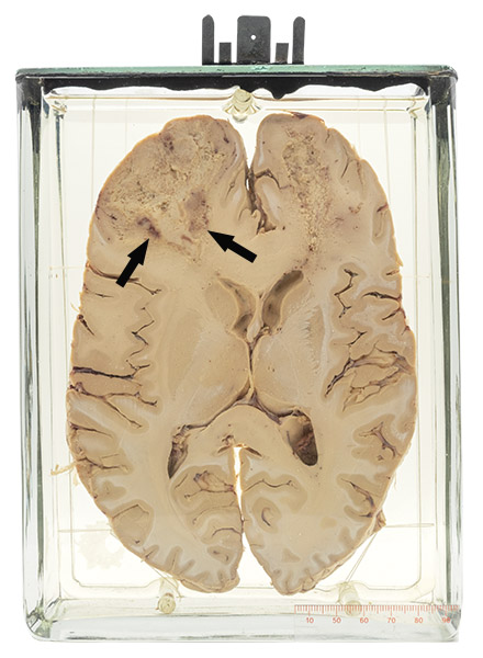 Glioblastoma multiforme