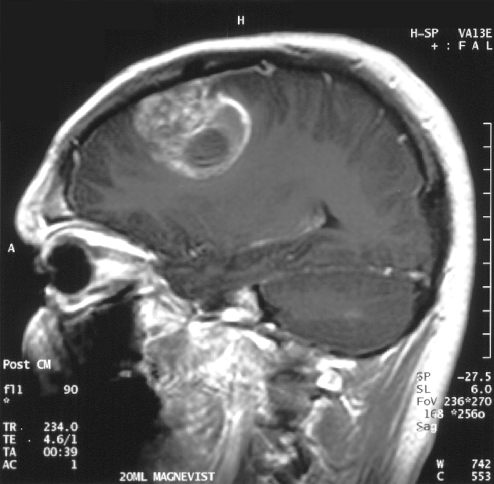 MRI showing the typical appearance of a glioblastoma multiforme 