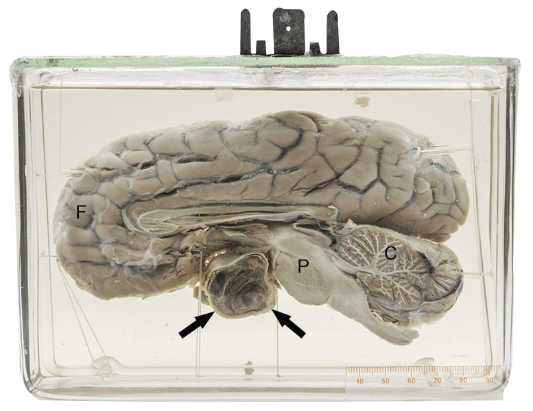 Cerebral aneurysms