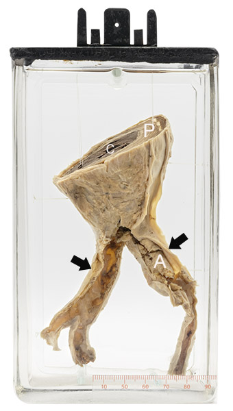 Abdominal aorta: Thrombosis