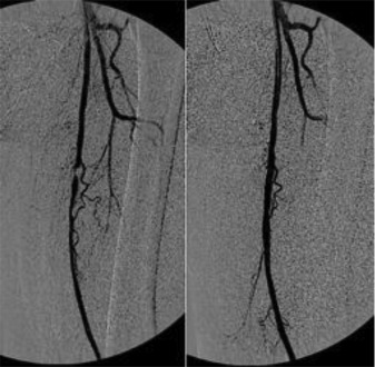 Intraoperative angiography of the superficial femoral artery, before and after stenting