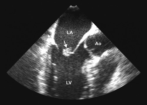 An image from a cardiac ultrasound showing a small mass on the mitral valve (arrow) representing non-bacterial thrombotic endocarditis in a patient with antiphospholipid syndrome 