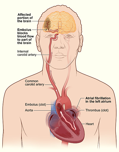 The mechanism by which atrial thrombus can cause stroke through embolization. 