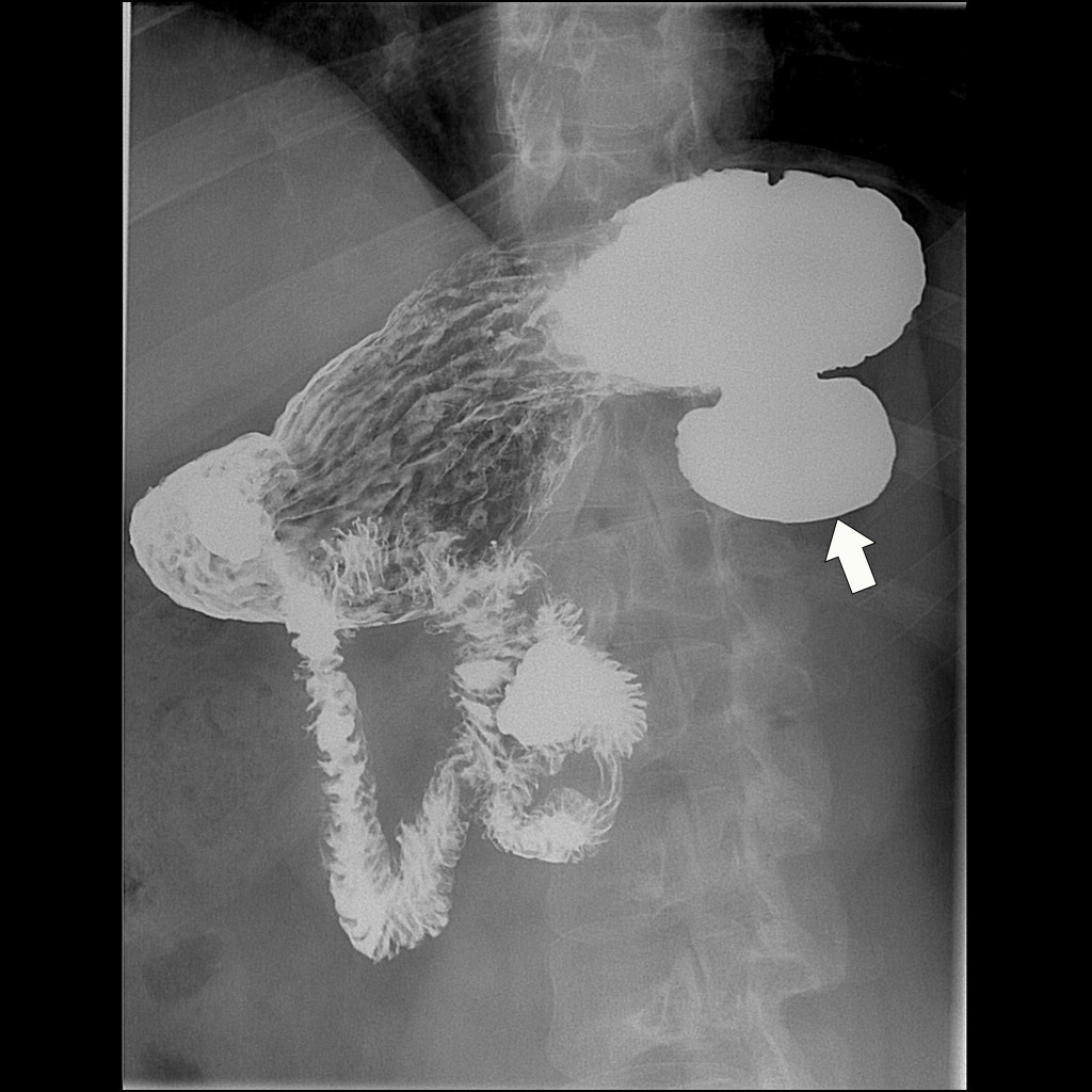 X ray showing diverticulum