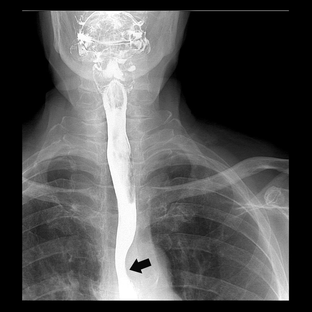 X ray