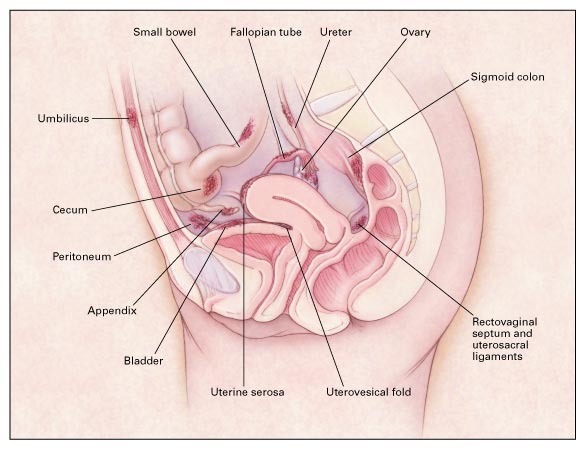 Common locations of endometriosis within the abdomen. 