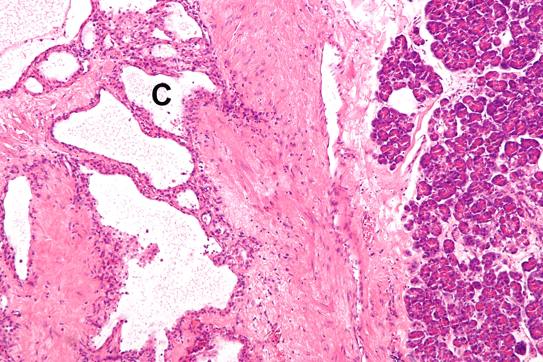 Histologic appearance showing tumor with small cysts on the left; normal pancreas on the right. 