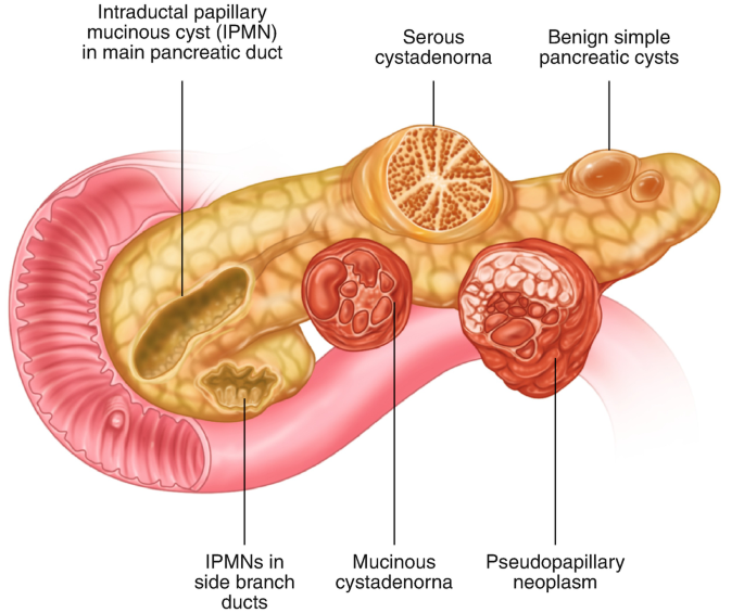 Different types of pancreatic cysts. 