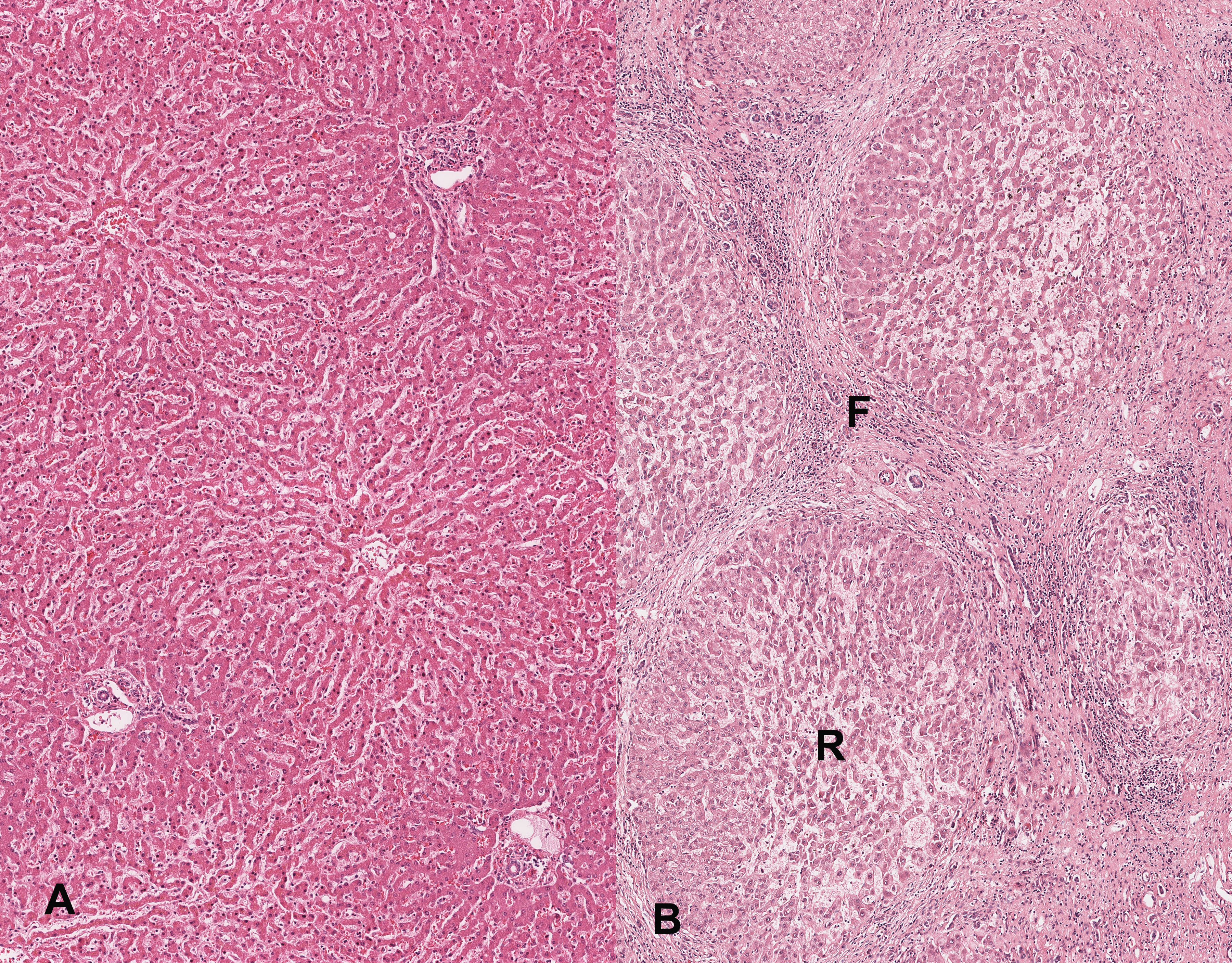 Histologic appearance of normal liver and a cirrhotic liver 